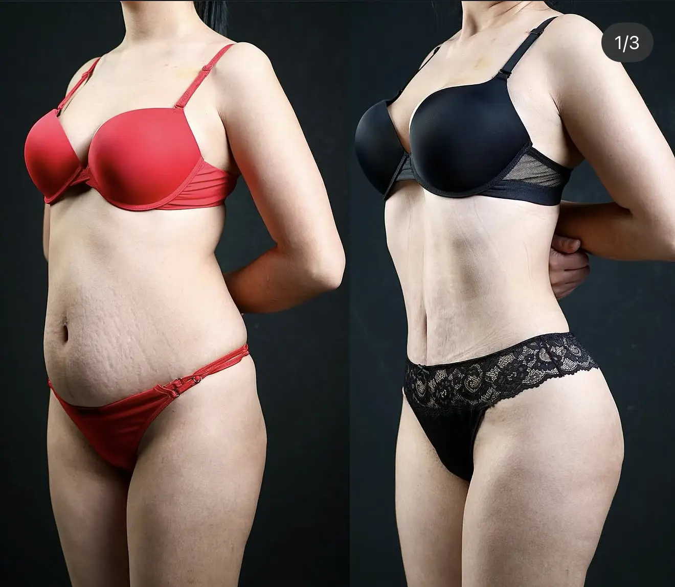 Abdominoplastika (Qorin plastikasi)
