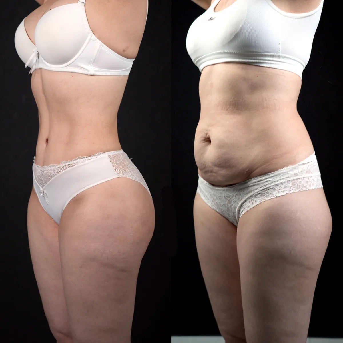 Abdominoplastika (Qorin plastikasi)