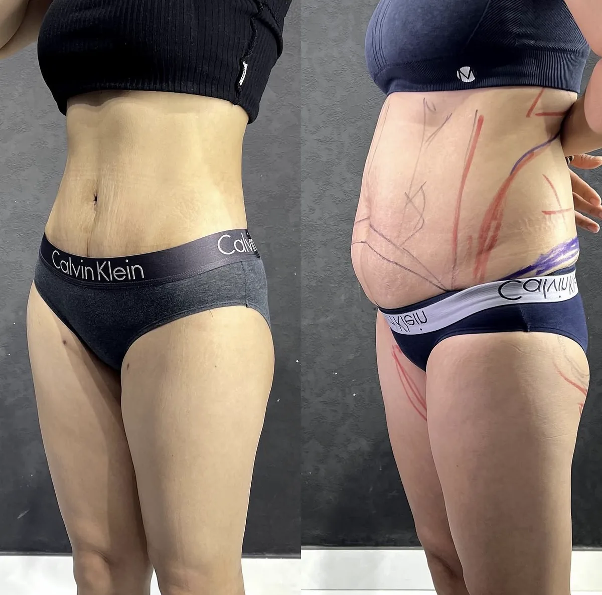 Abdominoplastika (Qorin plastikasi)