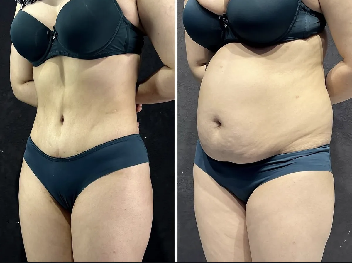 Abdominoplastika (Qorin plastikasi)