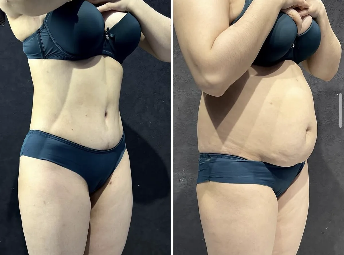 Abdominoplastika (Qorin plastikasi)