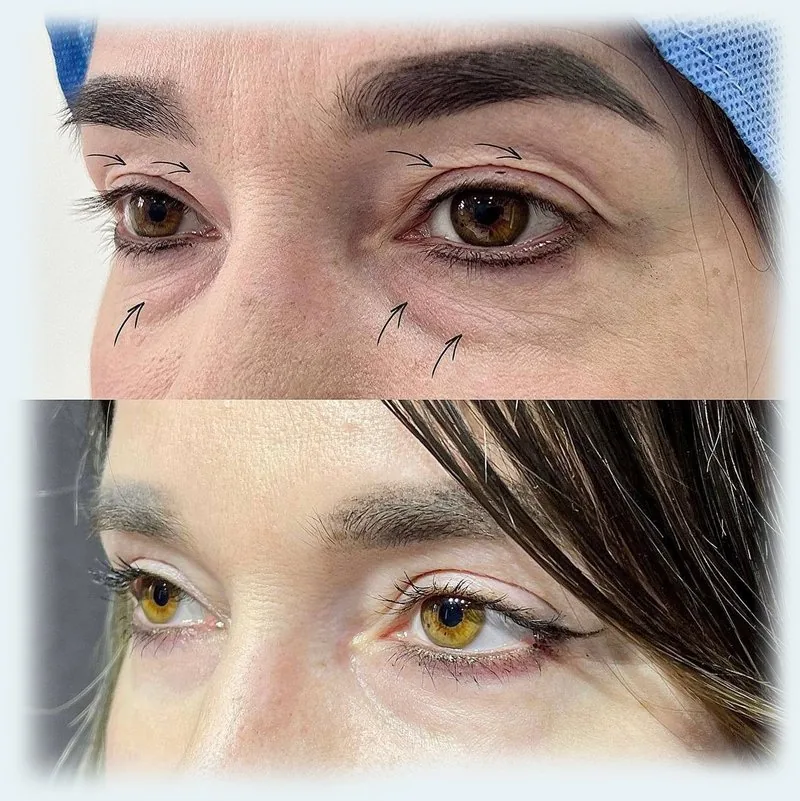 Qovoqlar plastikasi (Blefaroplastika)