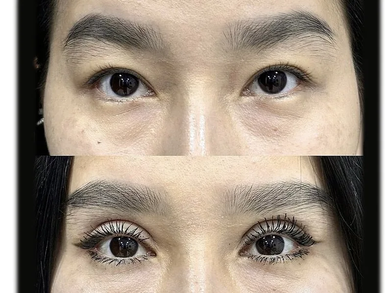 Qovoqlar plastikasi (Blefaroplastika)