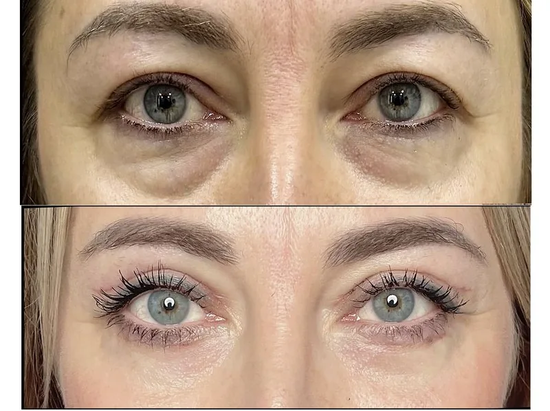 Qovoqlar plastikasi (Blefaroplastika)