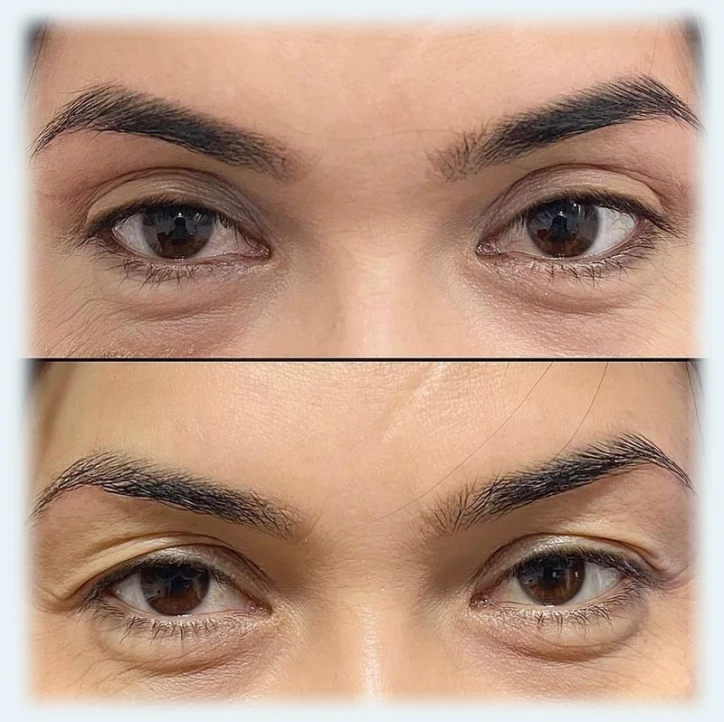 Qovoqlar plastikasi (Blefaroplastika)