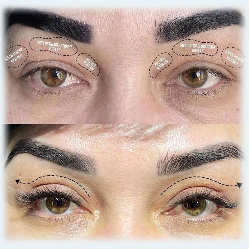 Qovoqlar plastikasi (Blefaroplastika)