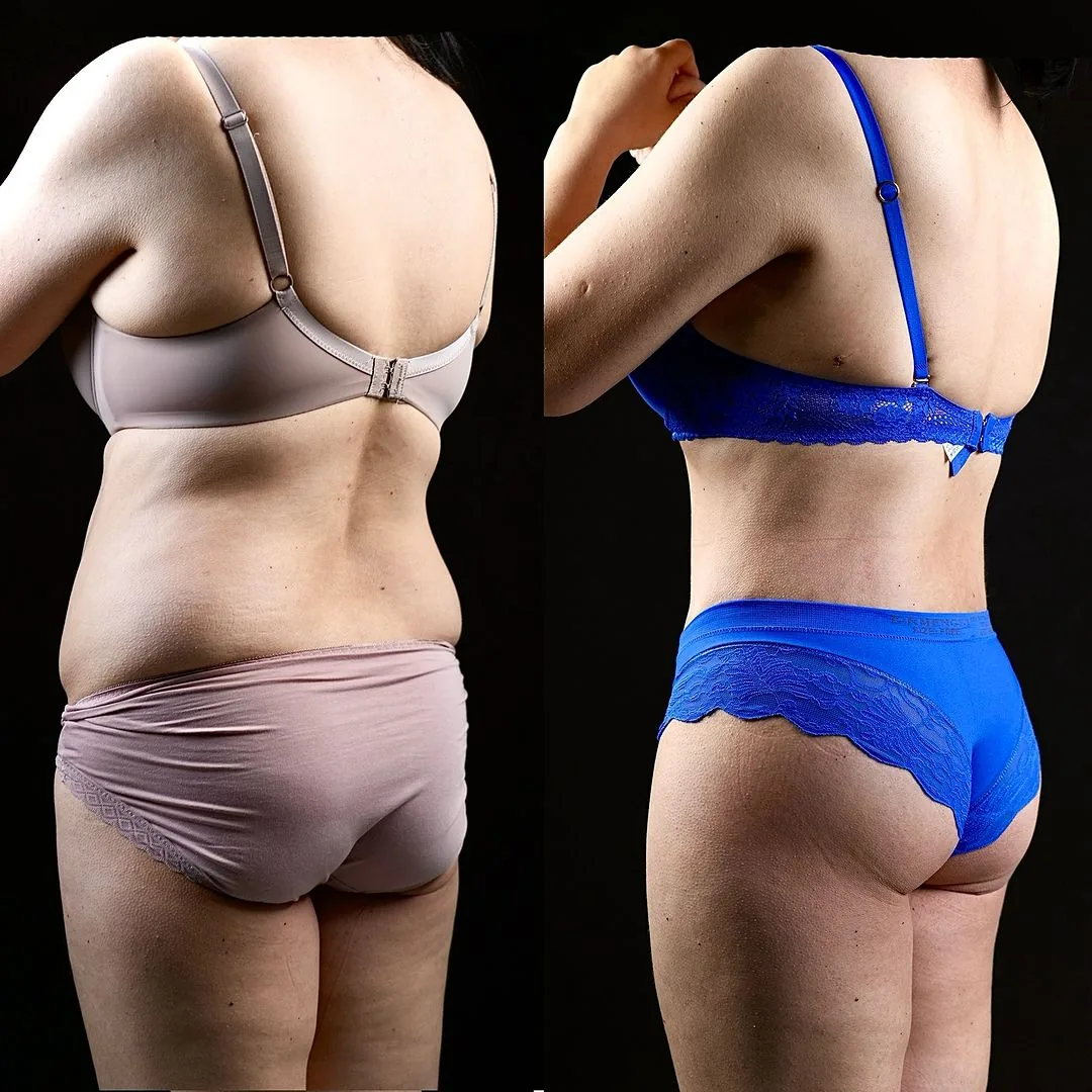 Body Lifting