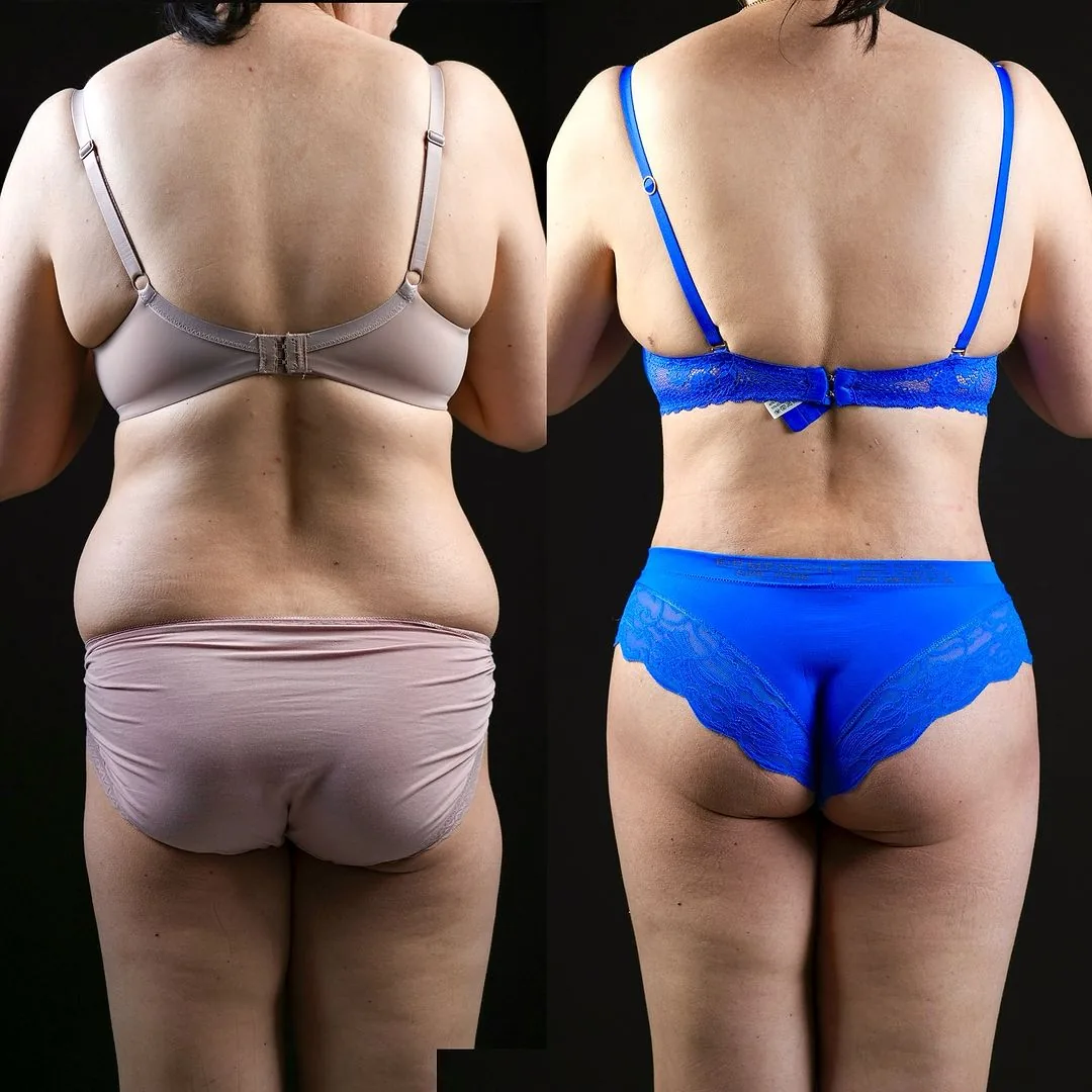 Body Lifting