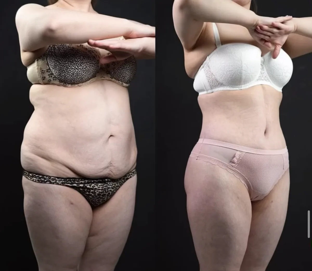 Body Lifting