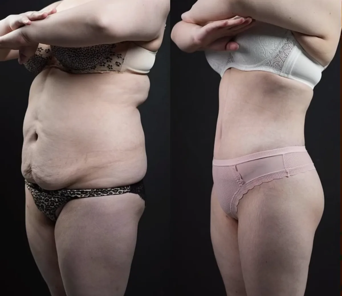 Body Lifting