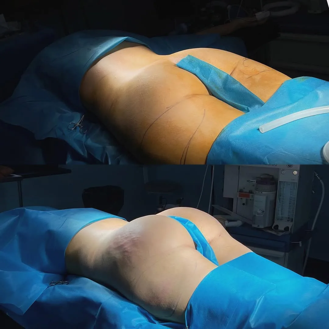 Liposaksiya 360°