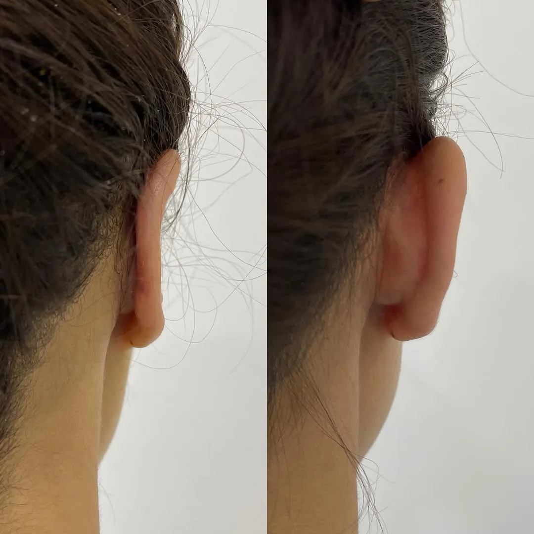 Quloqlar plastikasi (otoplastika)
