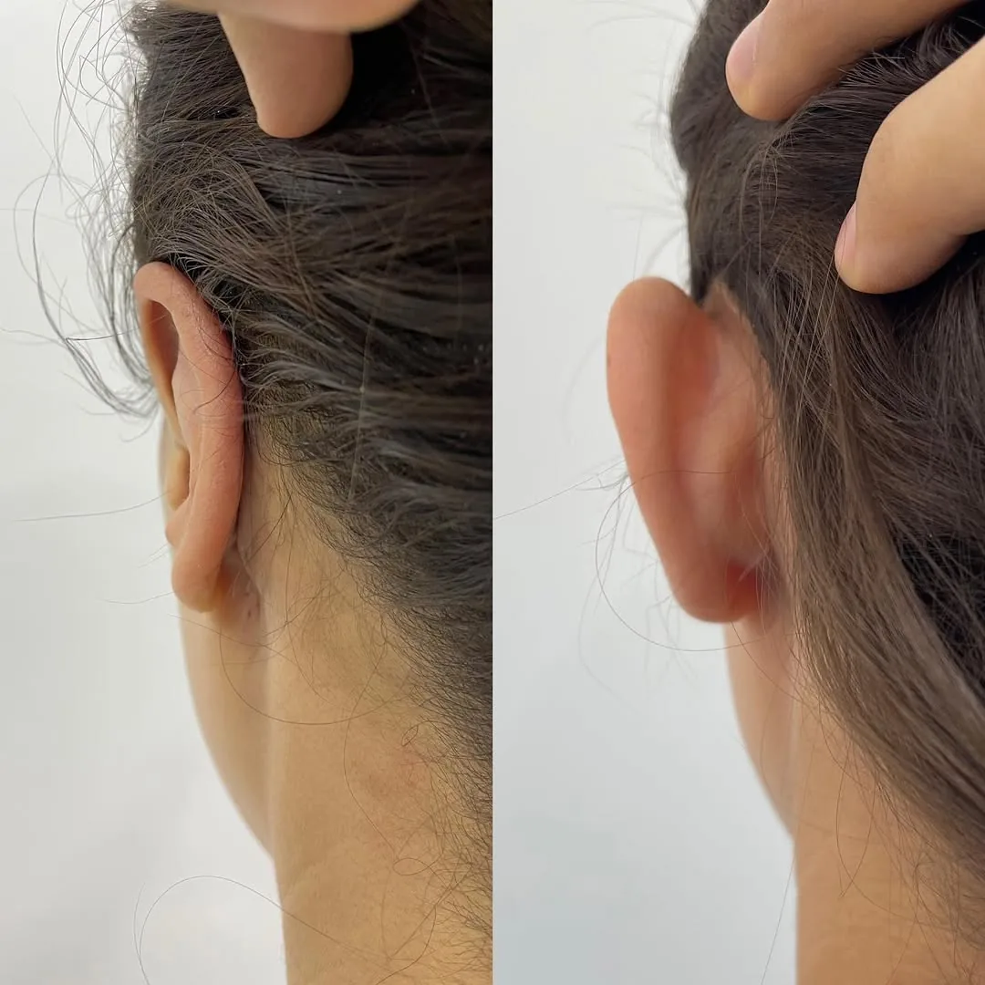 Quloqlar plastikasi (otoplastika)
