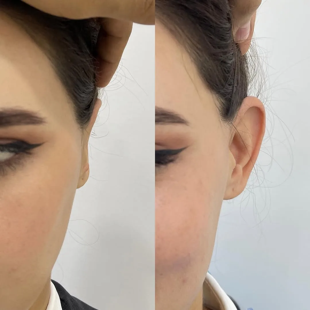 Quloqlar plastikasi (otoplastika)