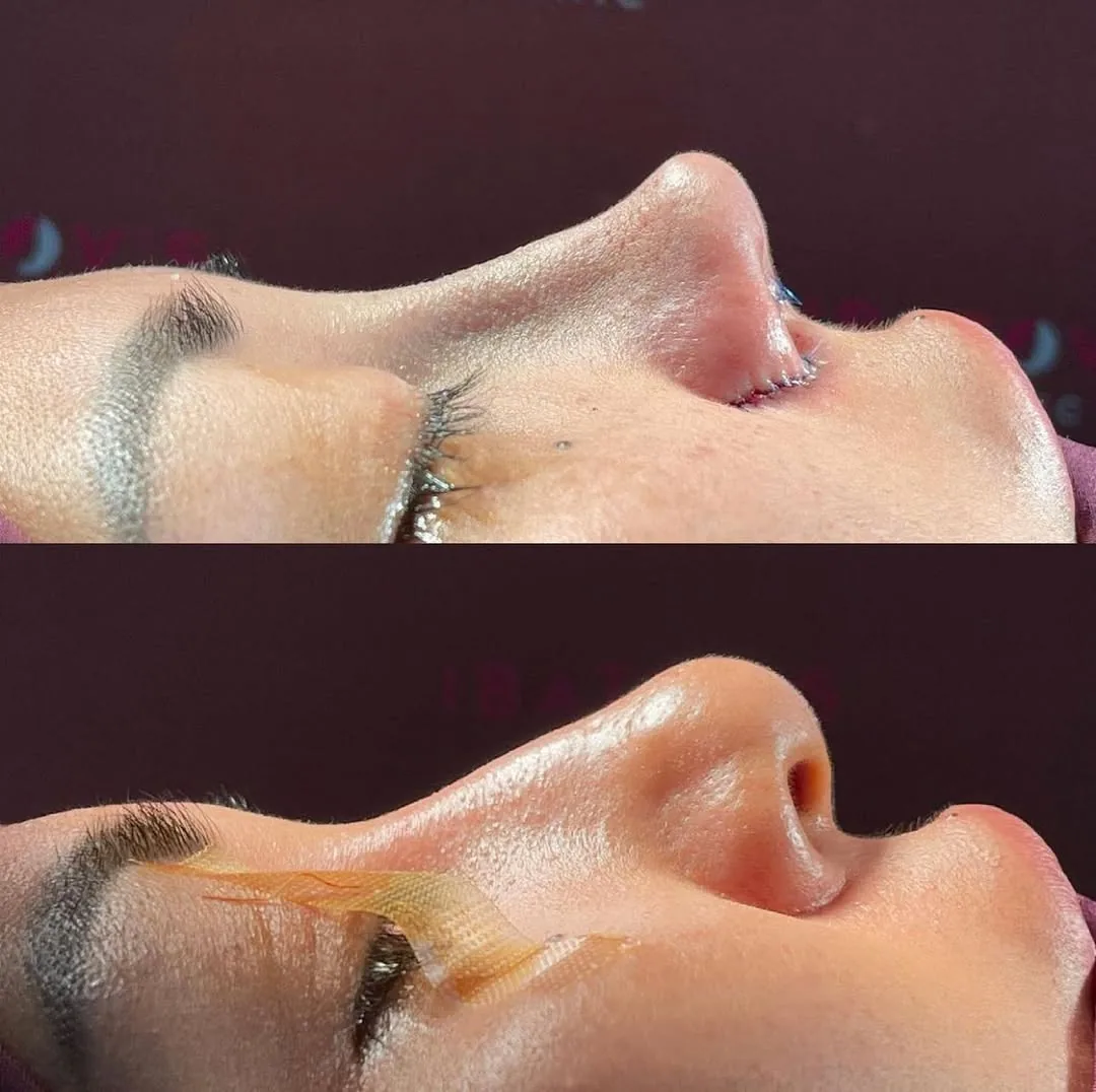 Rinoplastika (Burun plastikasi)