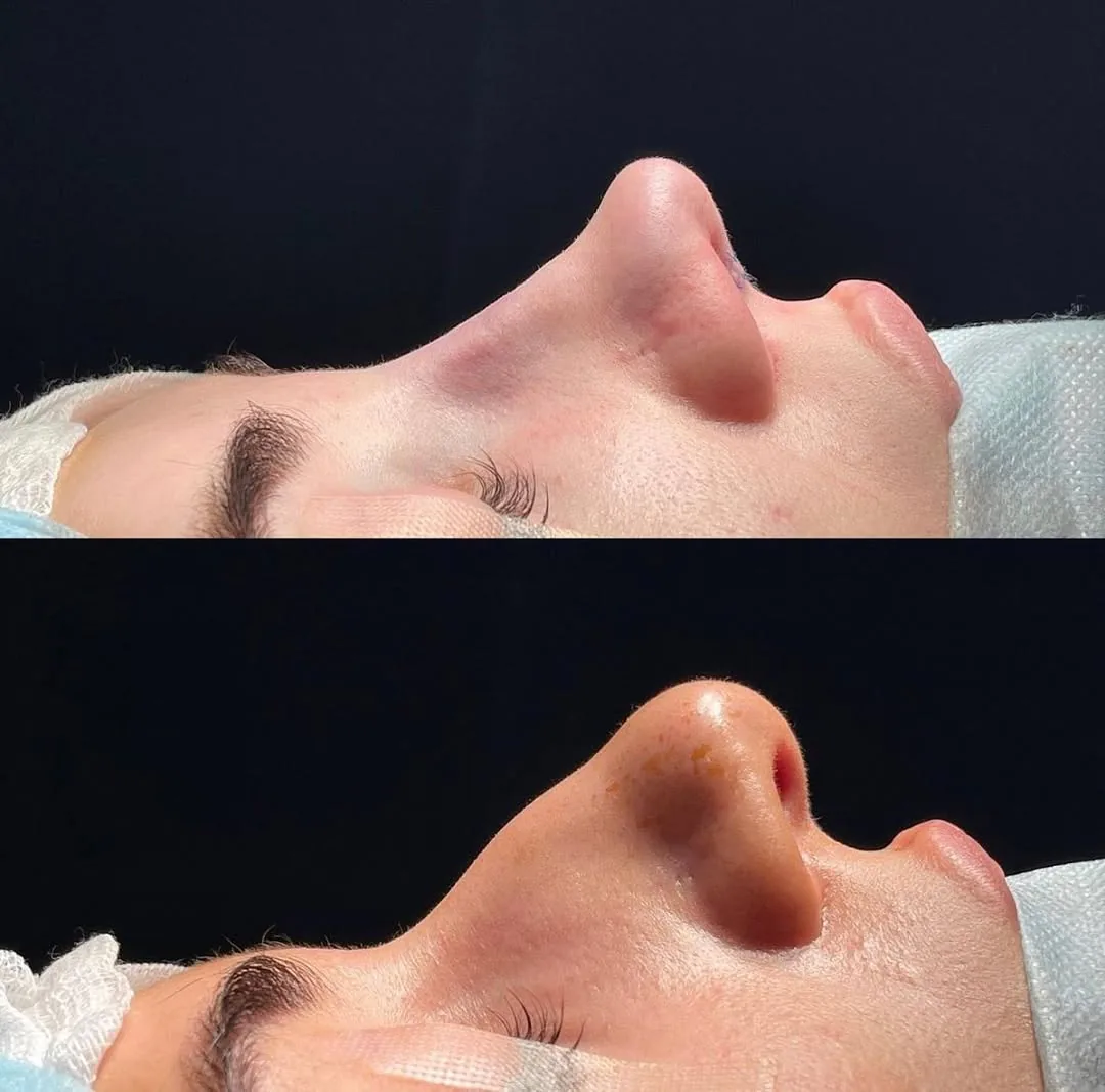 Rinoplastika (Burun plastikasi)