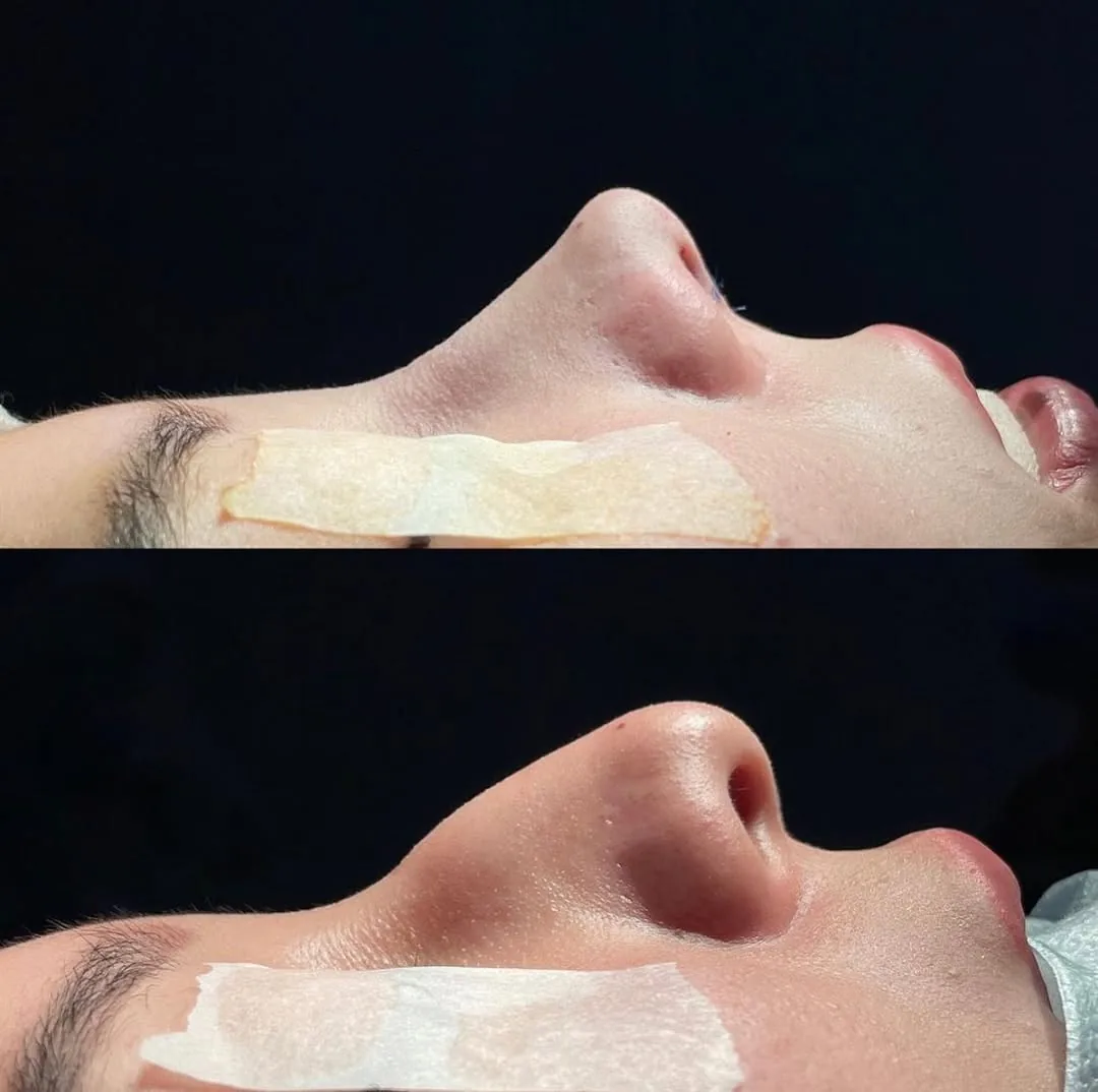 Rinoplastika (Burun plastikasi)