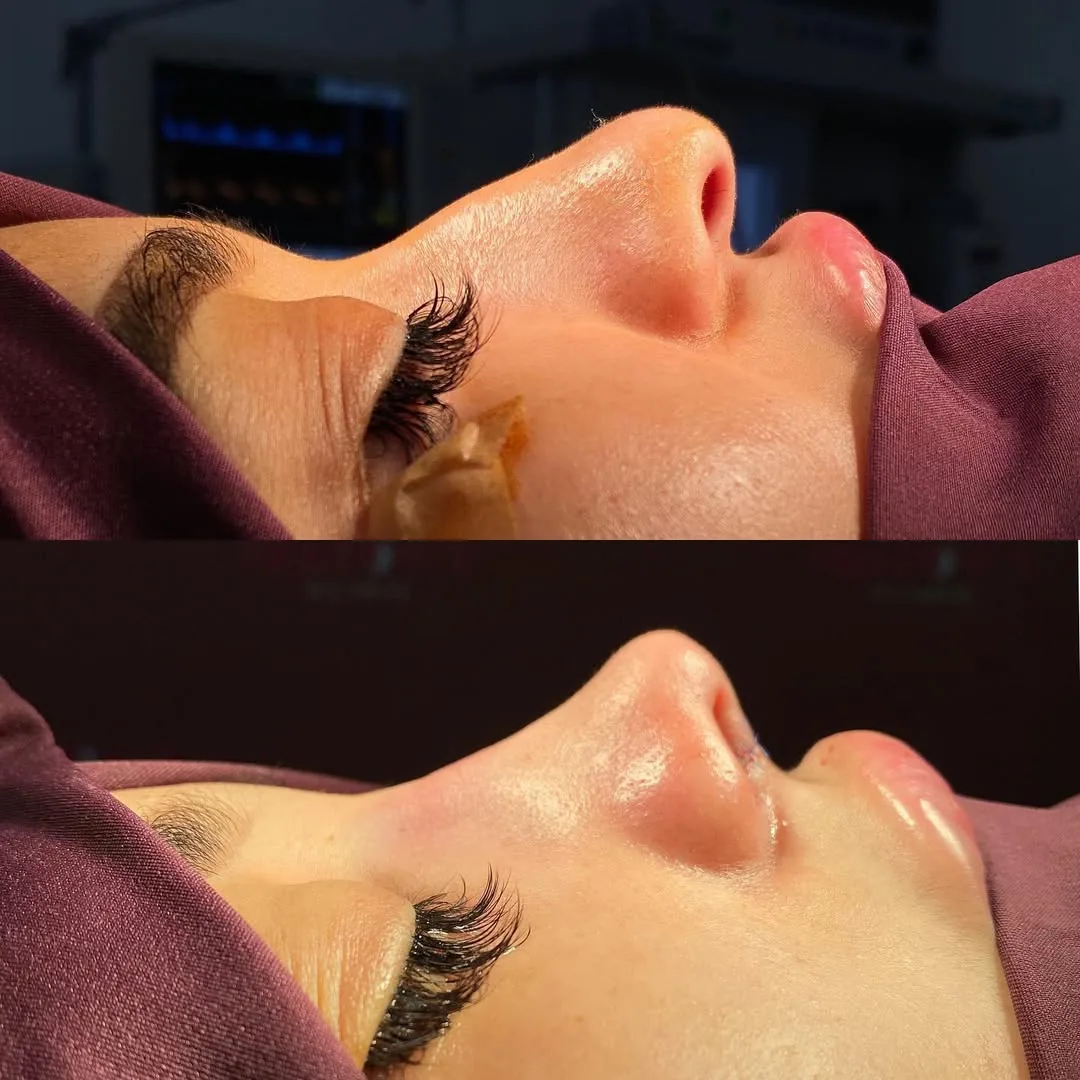 Rinoplastika (Burun plastikasi)