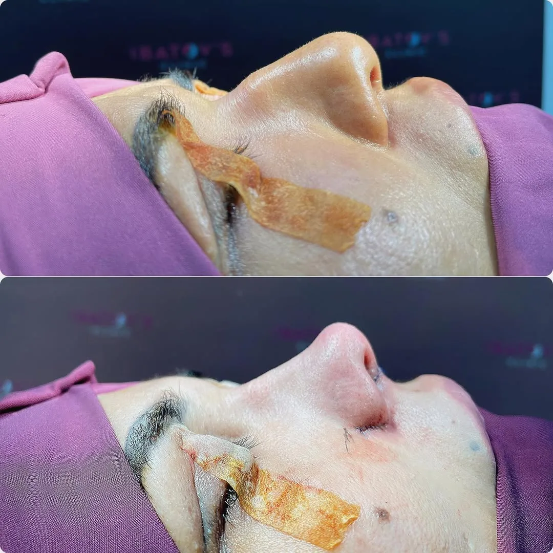 Rinoplastika (Burun plastikasi)