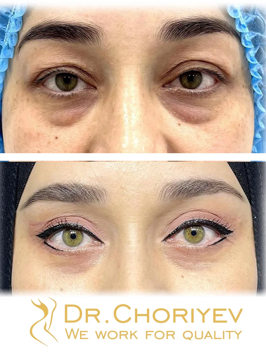 Qovoqlar plastikasi (Blefaroplastika)