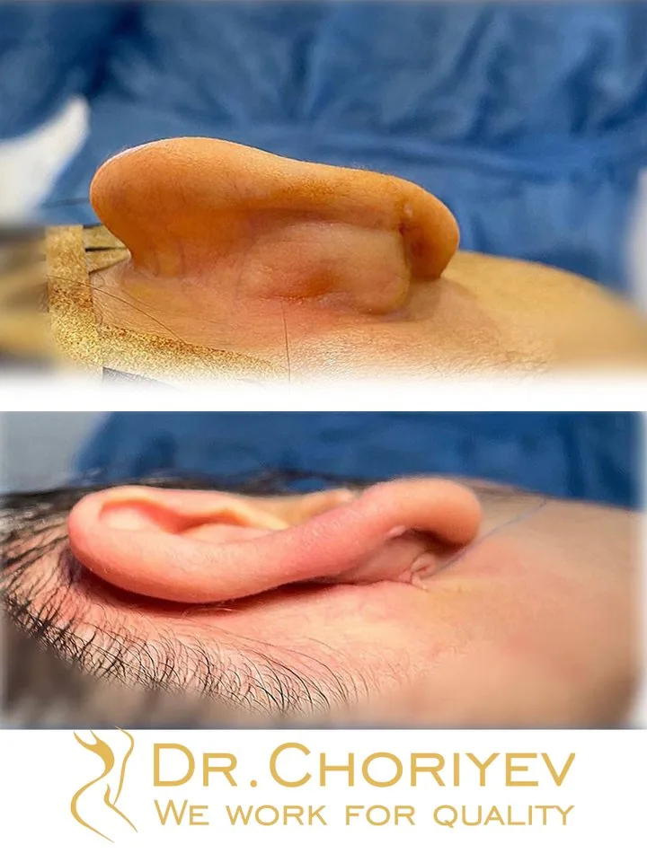 Quloqlar plastikasi (otoplastika)