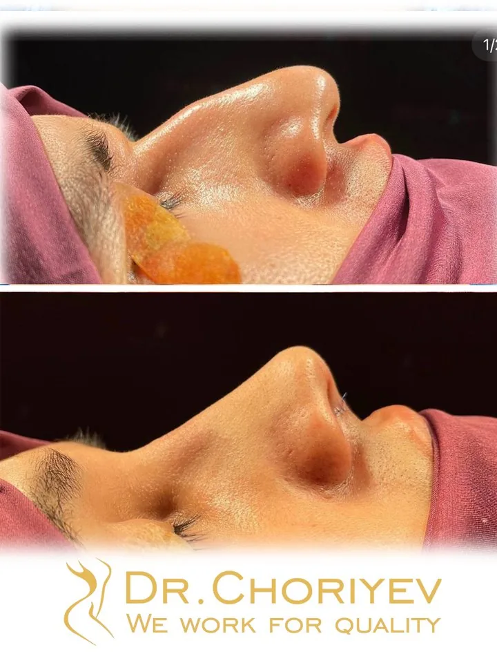 Rinoplastika (Burun plastikasi)