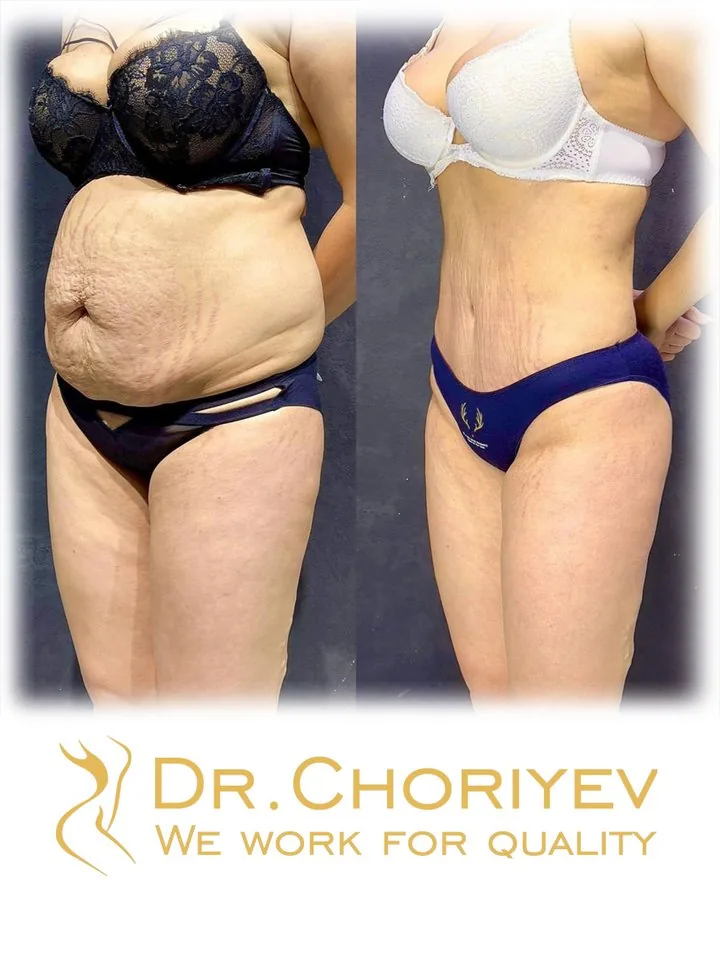 Abdominoplastika (Qorin plastikasi)